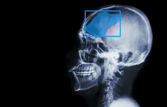 Semantic for AI in Brain Diagnosis